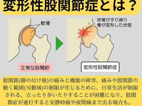 股関節の痛み