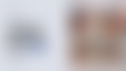 Concealing FUT Scars with Scalp Micropigmentation