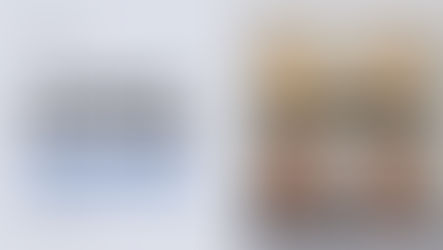 Scalp Micropigmentation for Alopecia Areata