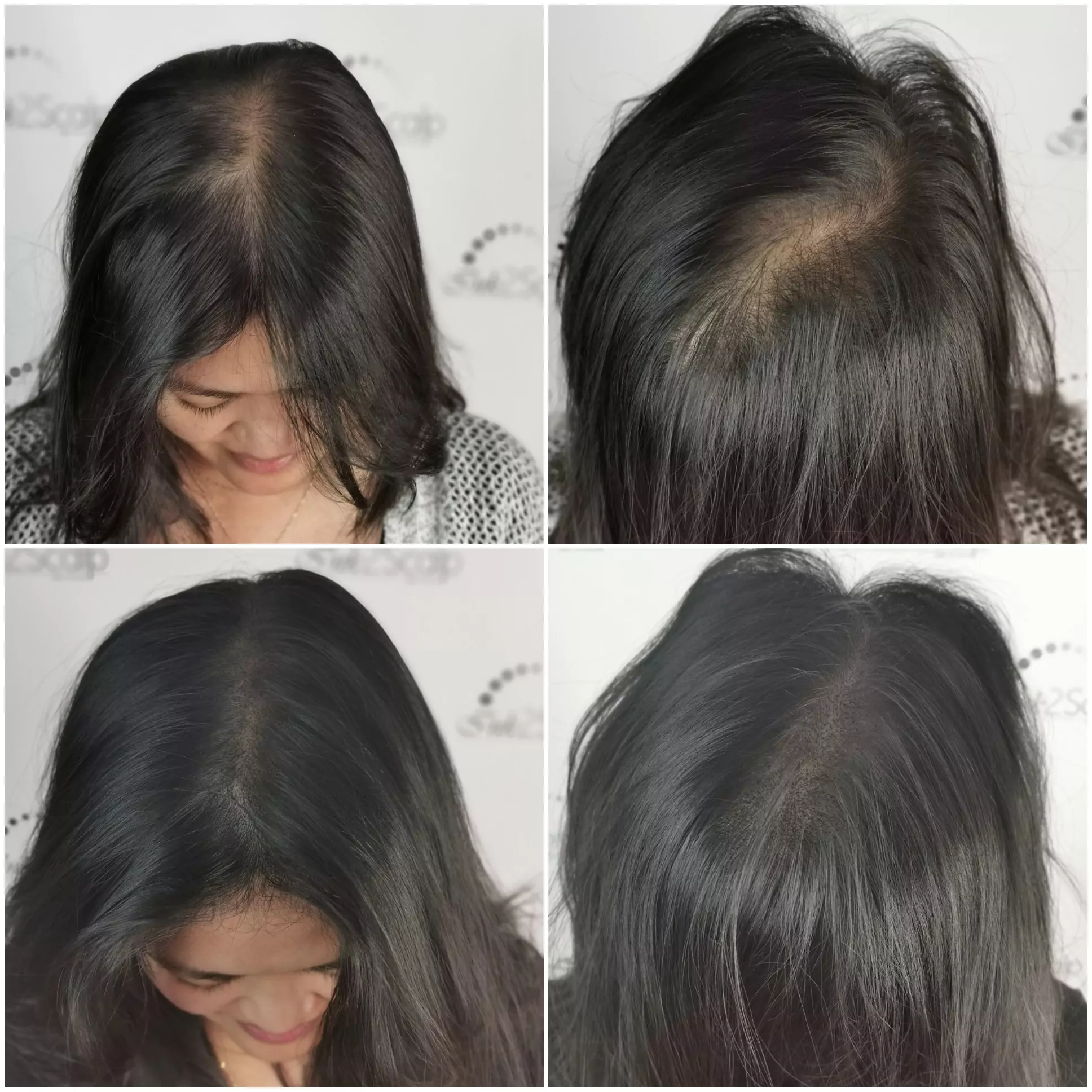 Female density Scalp Micropigmentation