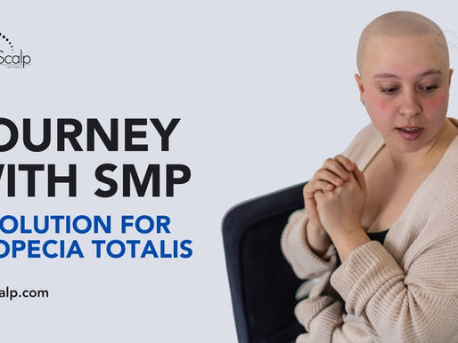 Alopecia Totalis Solution: Journey with SMP