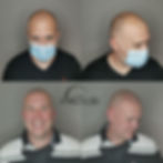 pickering before and after scalp micropigmentation