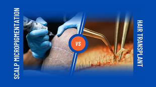 Hair Transplant vs Scalp Micropigmentation: Which Option is Right for You?