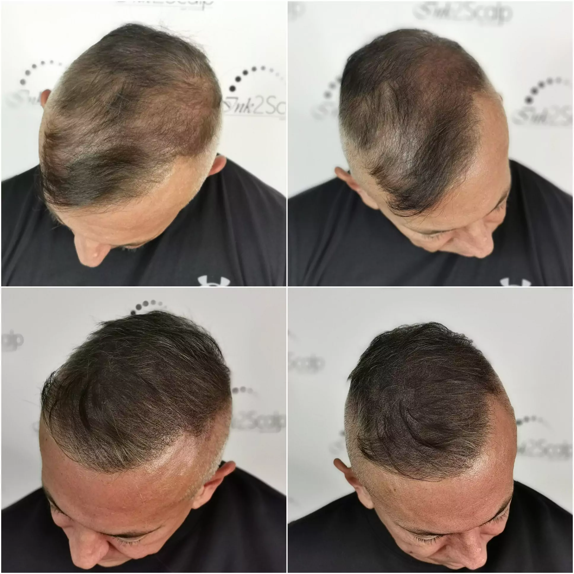 Male density Scalp Micropigmentation