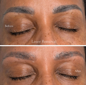 Moving away from those harsh lines to a more natural you.