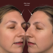 Safe, gradual removal of unwanted pigment.