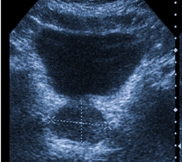 prostata