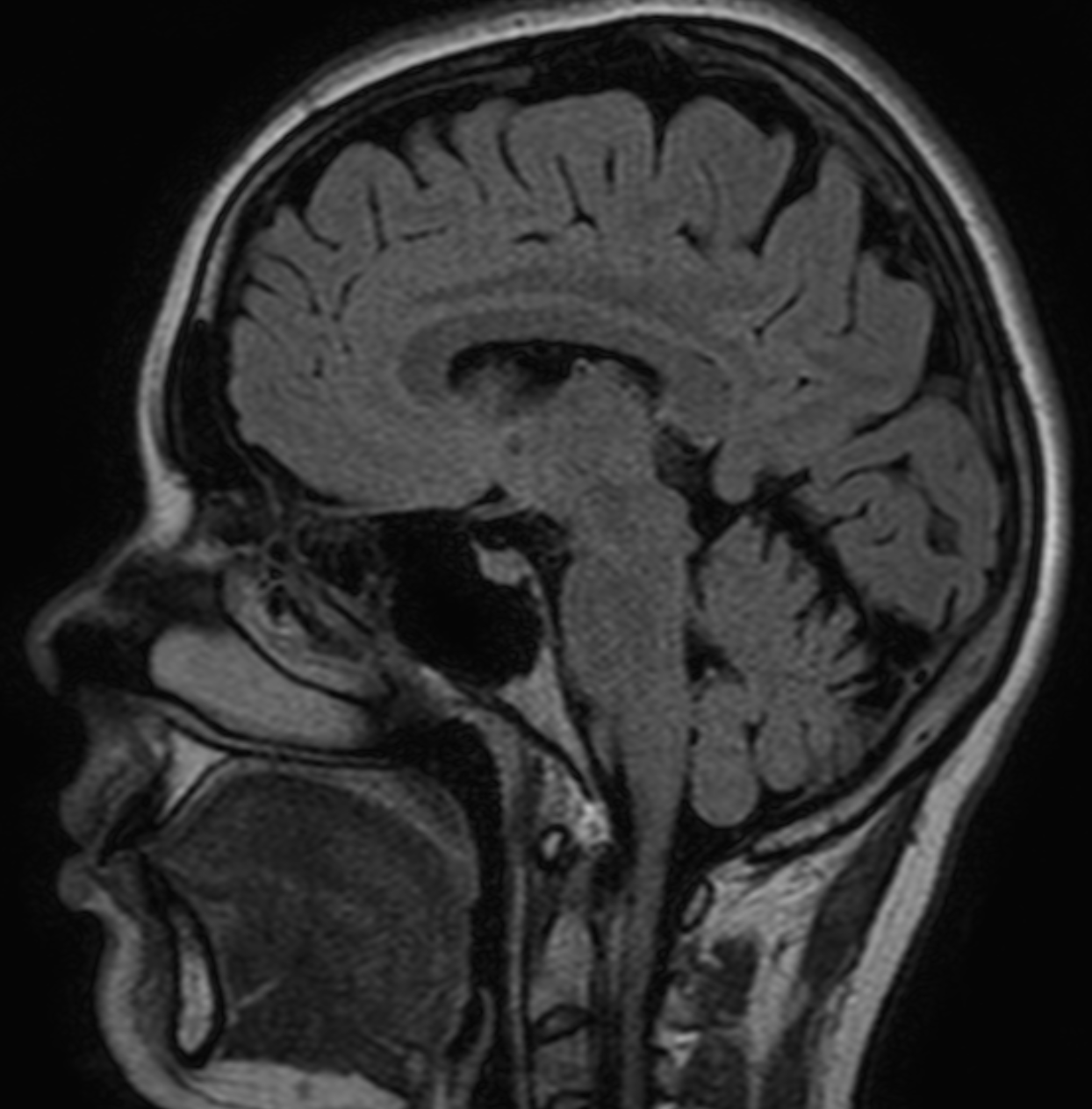 hypophysis знімок МРТ