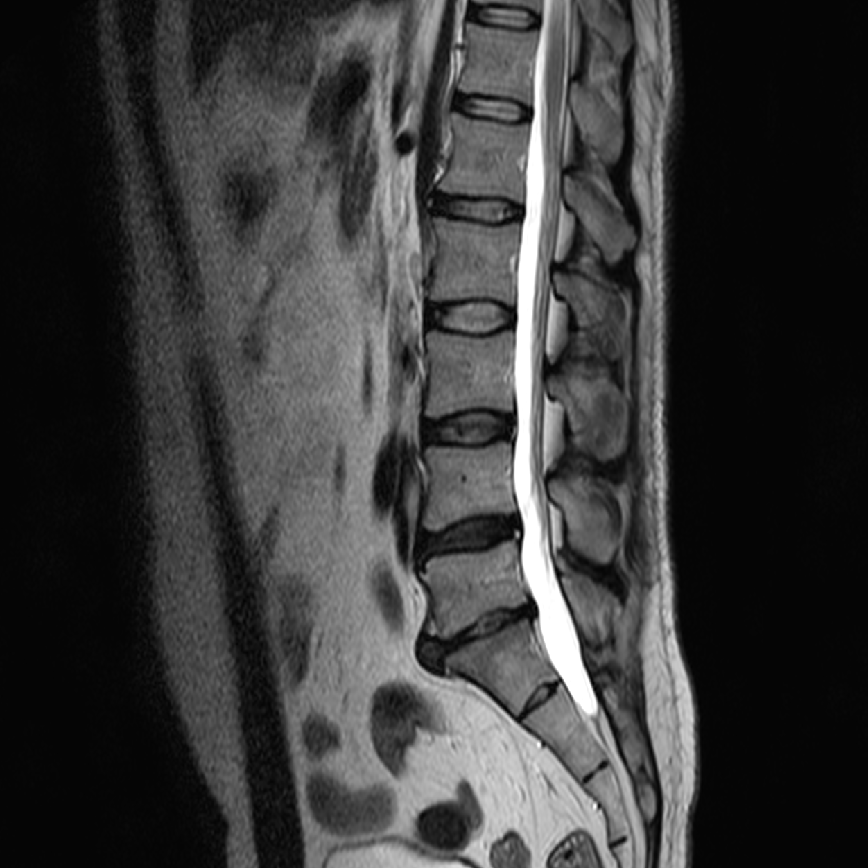 Lumbar знімок МРТ