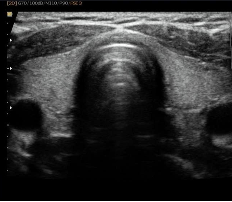 tyrioid_gland