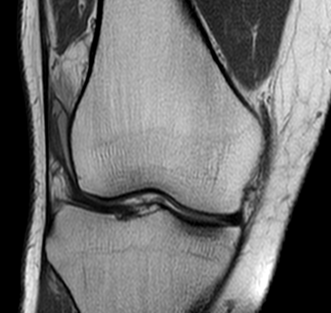 Knee знімок МРТ