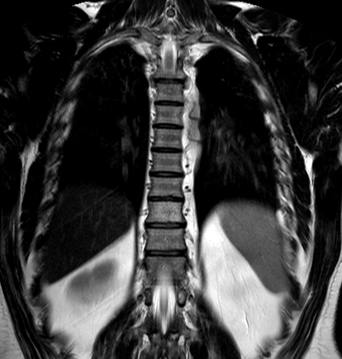 Thoracic знімок МРТ