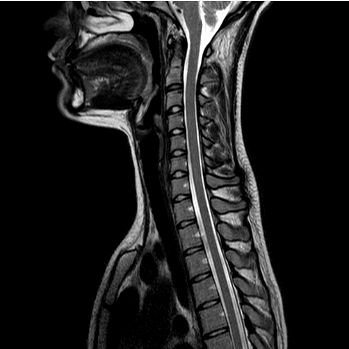 cervical знімок МРТ