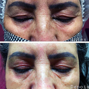 blefaroplastia