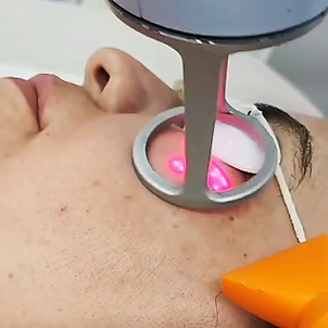 laser lavieen.png