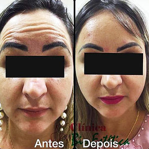 harmonização facial