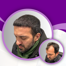 Saç əkimi əvvəli və sonrası. Before and after photo of hair implant. До и после пересадки волос.