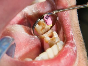 Dental Filling Treatment