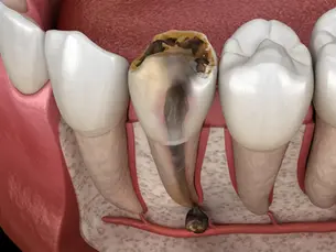 Tooth Decay Treatments