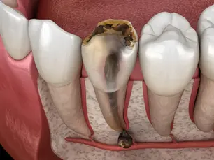 Tooth Decay Treatments
