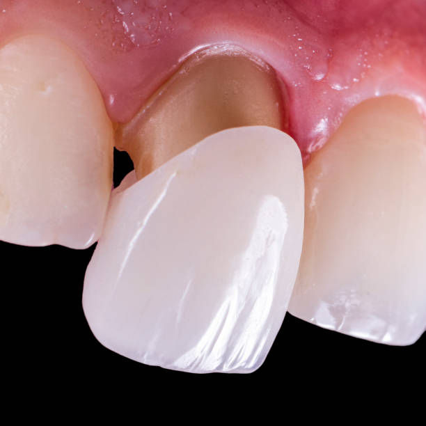 dental crown_2.jpg