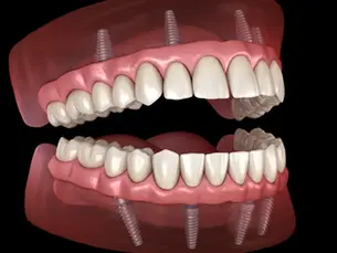 Dental All on Four Implant Treatment