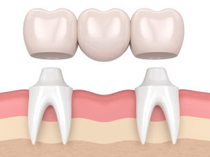 Dental Bridge Treatment