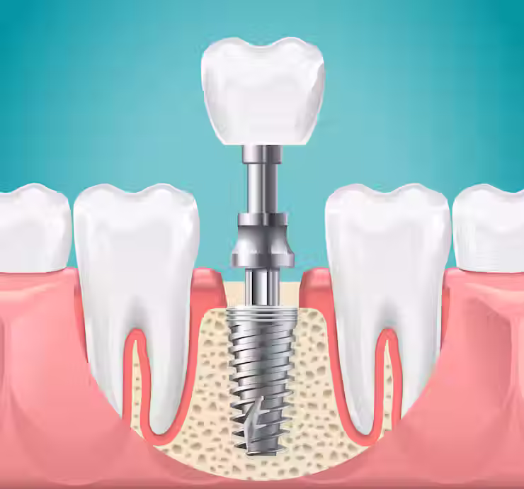 Dental Implant Treatment