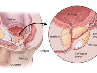 Prostate Diseases