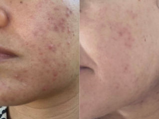 Better Healthier skin