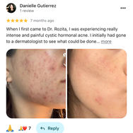 Happy treated skin or Acne Condition