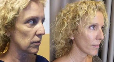 lucie brfore and after.webp