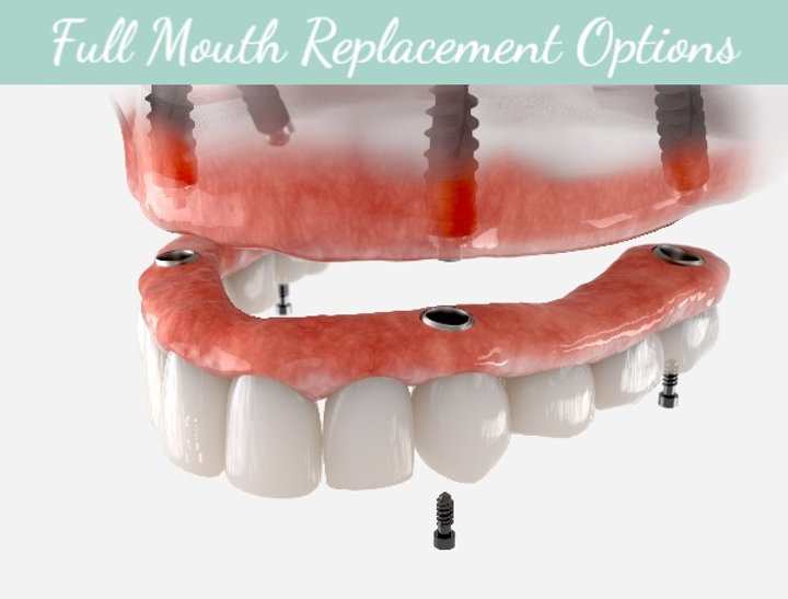 The Ultimate Guide to Replacing All Your Teeth with Implants: Costs ...