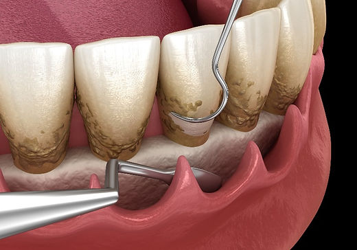 Pocket reduction surgery, osseous surgery
