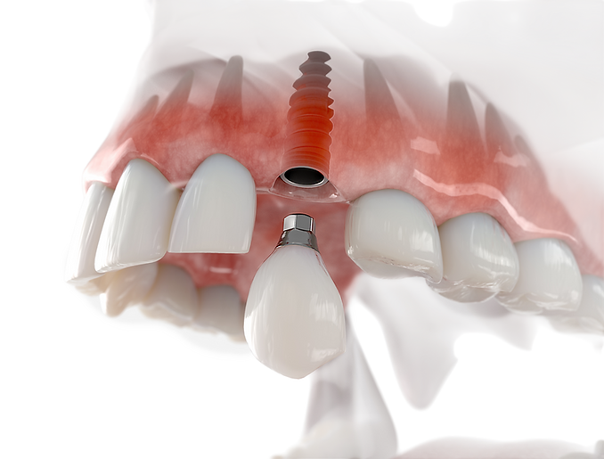 dental implant_edited_edited.png
