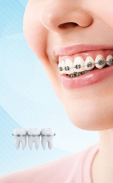 Braces Mobile.jpg