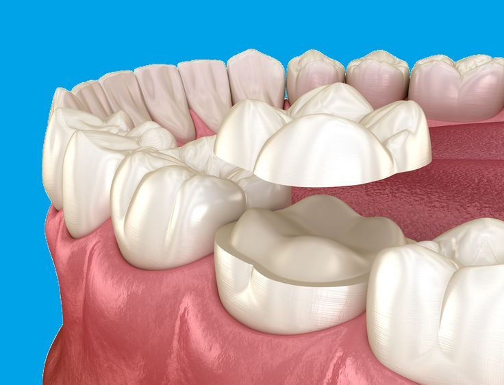 Ceramic Inlays & Onlays – A Smarter Alternative to Crowns