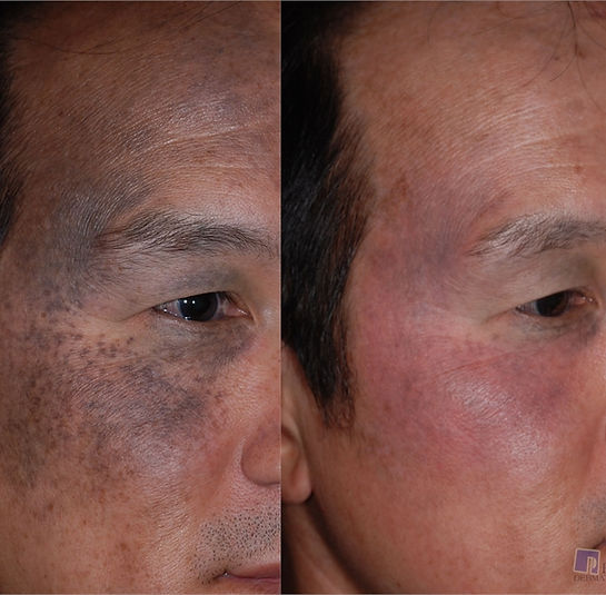 Nevus-of-Ota-Before-After-Treatment-Pima-Dermatology.jpg