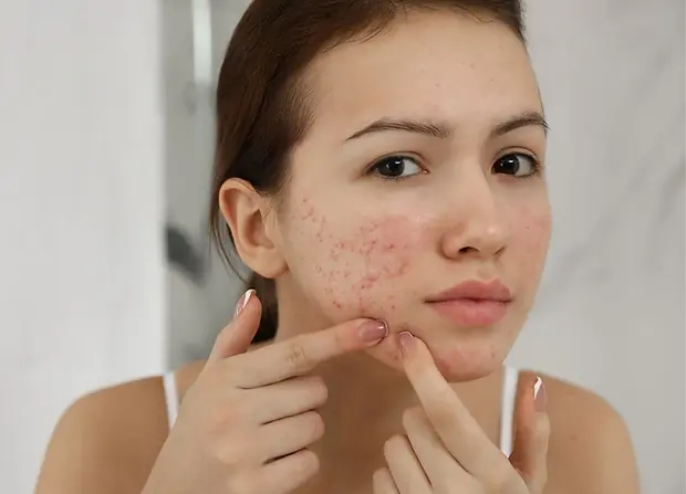 acne.jpg.webp