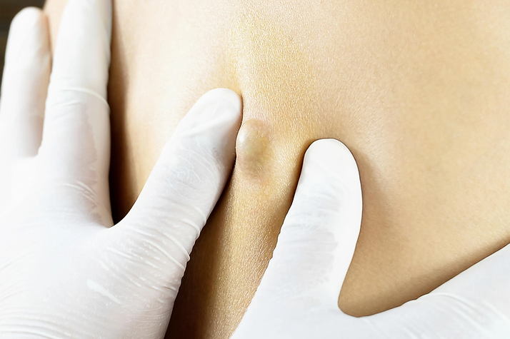 lipoma.jpg.webp