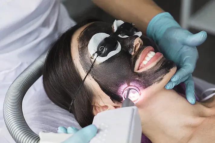 Laser_Carbon_Peel_732x549-thumbnail-732x549.jpg.webp