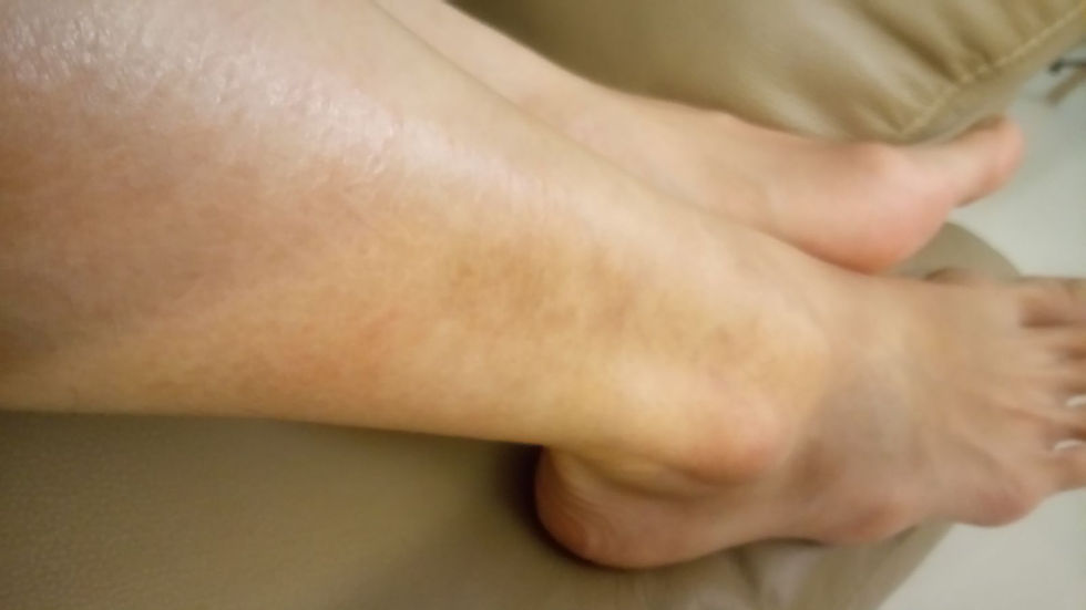 April 2018 Leg recovered