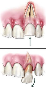 Knocked-out tooth