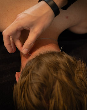 Acupunctuur