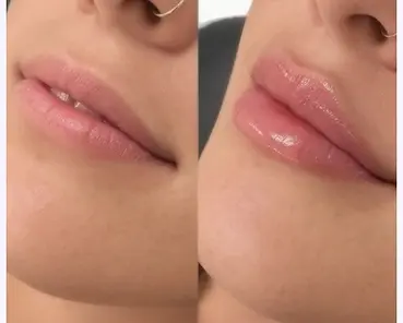 about-lip-fillers.webp