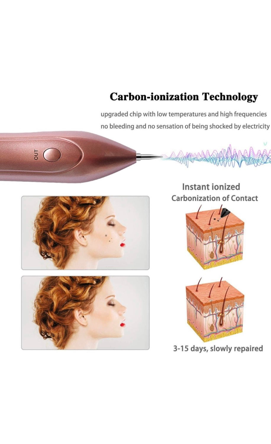 الصورة المصغرة: Carbon-Ionization Technology demonstration with before and after skin treatment graphic.