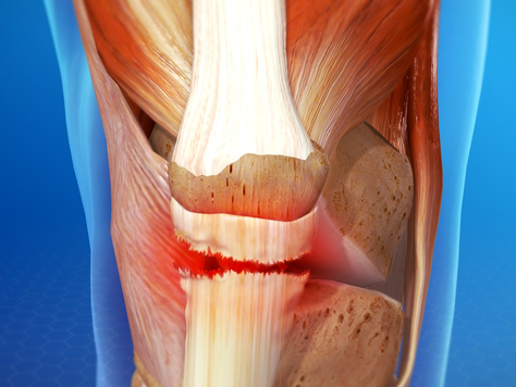 Patella Rupture. Knee caps off to the best treatment