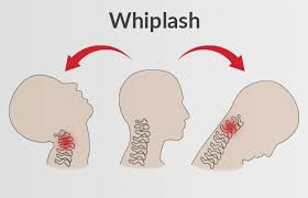 How Physiotherapy Can Help With Whiplash Recovery After an Accident