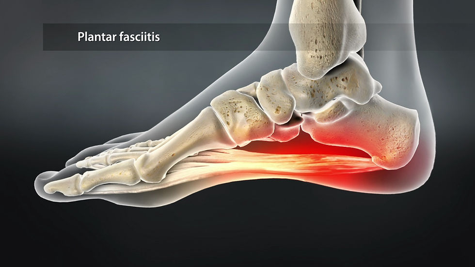 Plantar Fasciitis: Heel Pain and How Physiotherapy Can Help