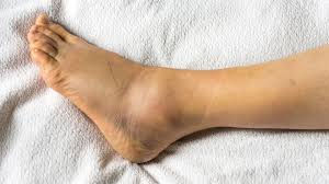 Returning to Sport After an Ankle Sprain: How Physiotherapy Helps
